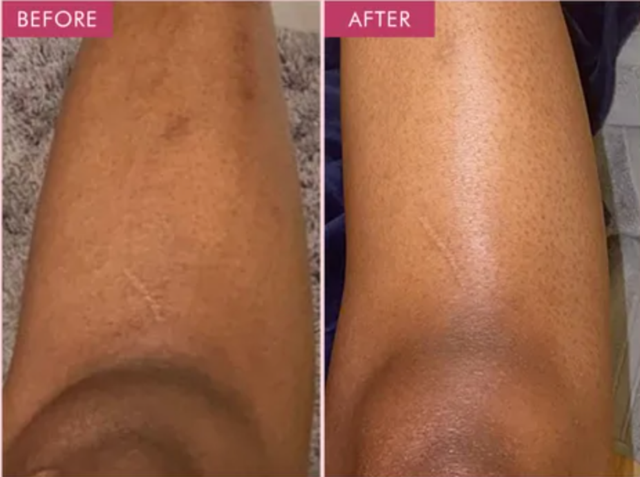 Elarae™ Exfoliating Gel